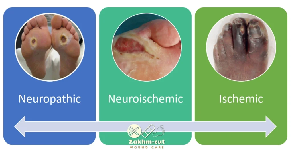 انواع زخم دیابتی