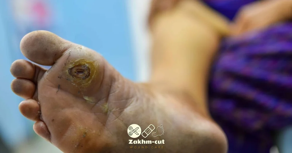 زخم دیابتی چیست؟