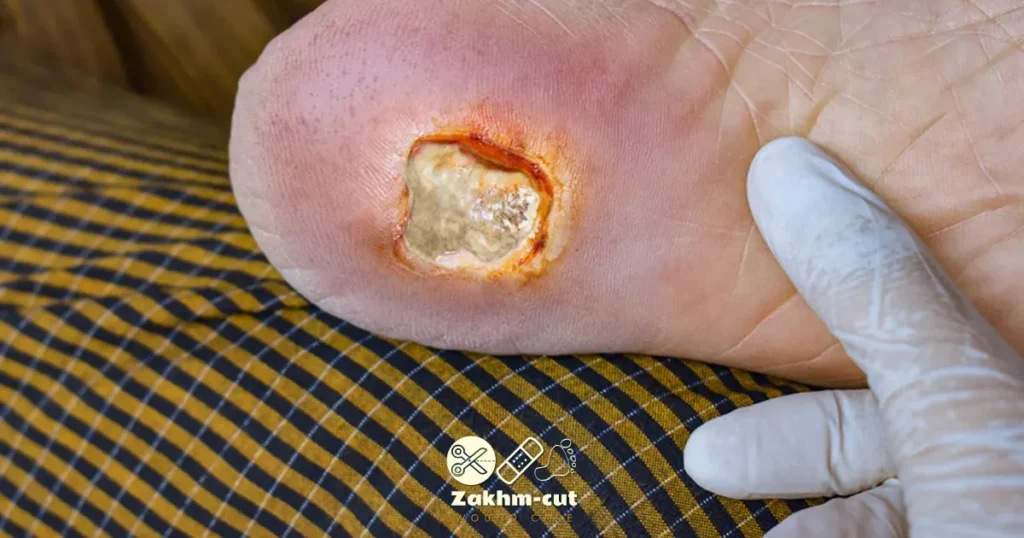 درمان زخم عفونی دیابتی