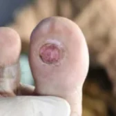 درمان زخم دیابتی