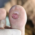 درمان زخم دیابتی