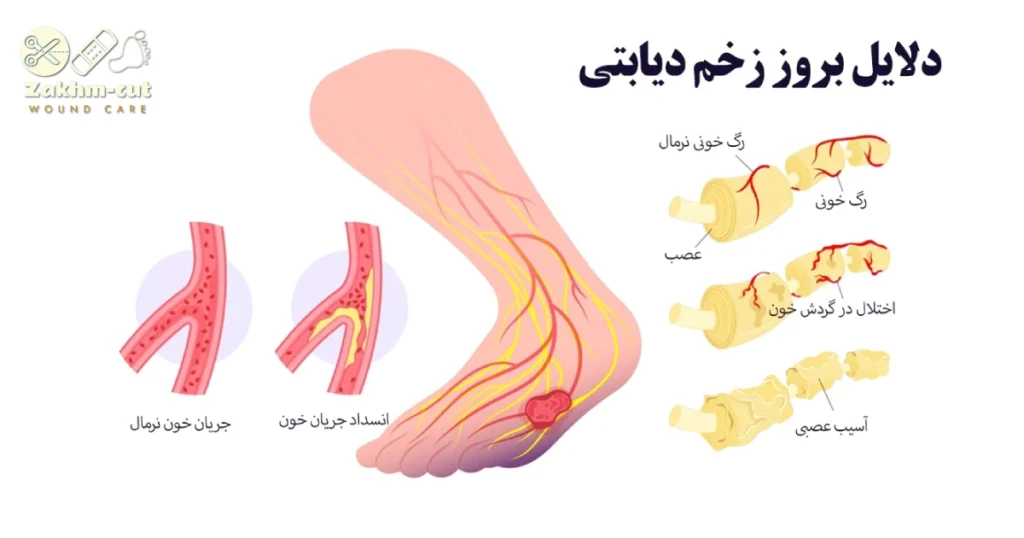 علت بروز زخم پای دیابتی