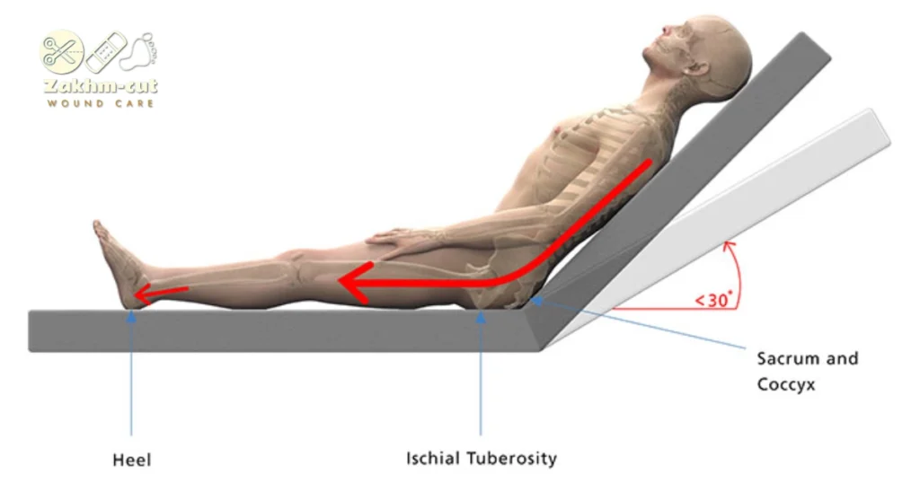 علت ایجاد زخم بستر