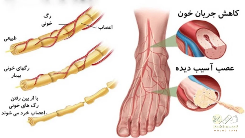 درمان نوروپاتی دیابتی