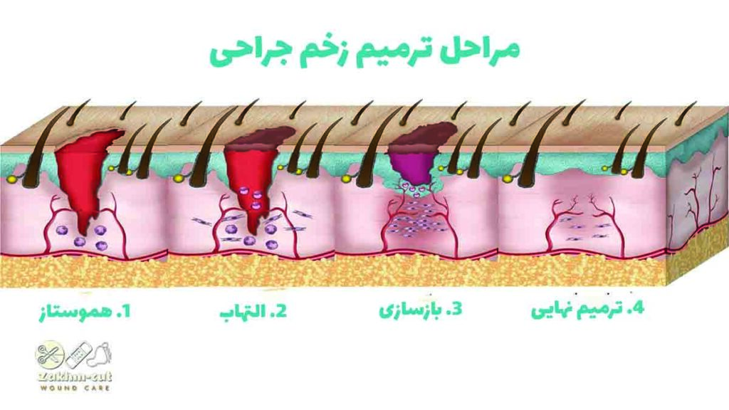 مراحل ترمیم زخم جراحی